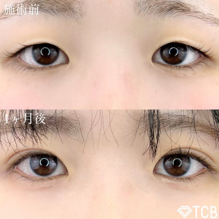 二重埋没法(担当医:TCB 医師)の症例写真1