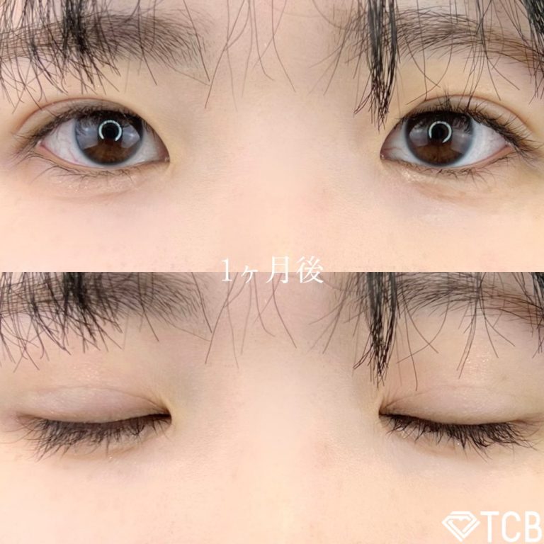 二重埋没法(担当医:TCB 医師)の症例写真2