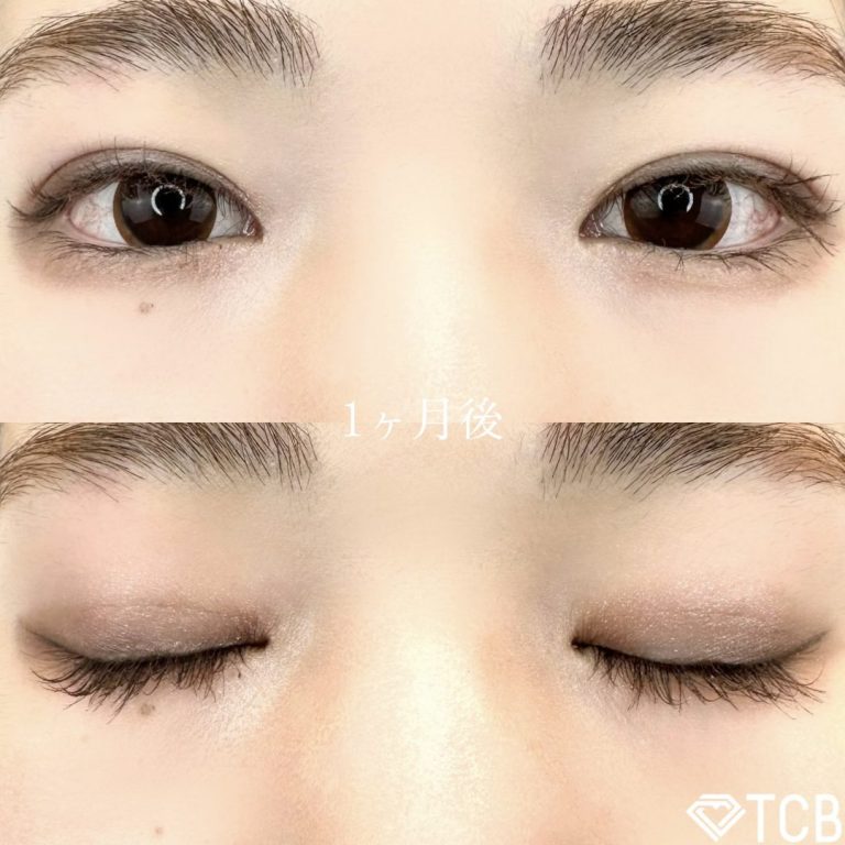 二重埋没法(担当医:TCB 医師)の症例写真2