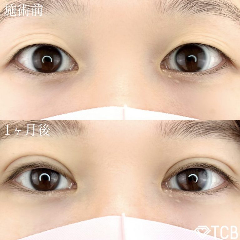 二重埋没法(担当医:TCB 医師)の症例写真1