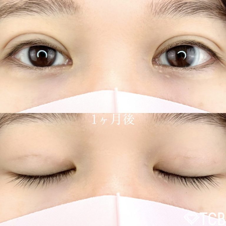 二重埋没法(担当医:TCB 医師)の症例写真2