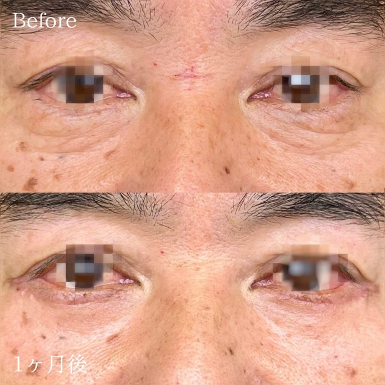 切開法による目の下のたるみ取り（下眼瞼除皺術）(担当医:林 弘樹 医師)の症例写真1