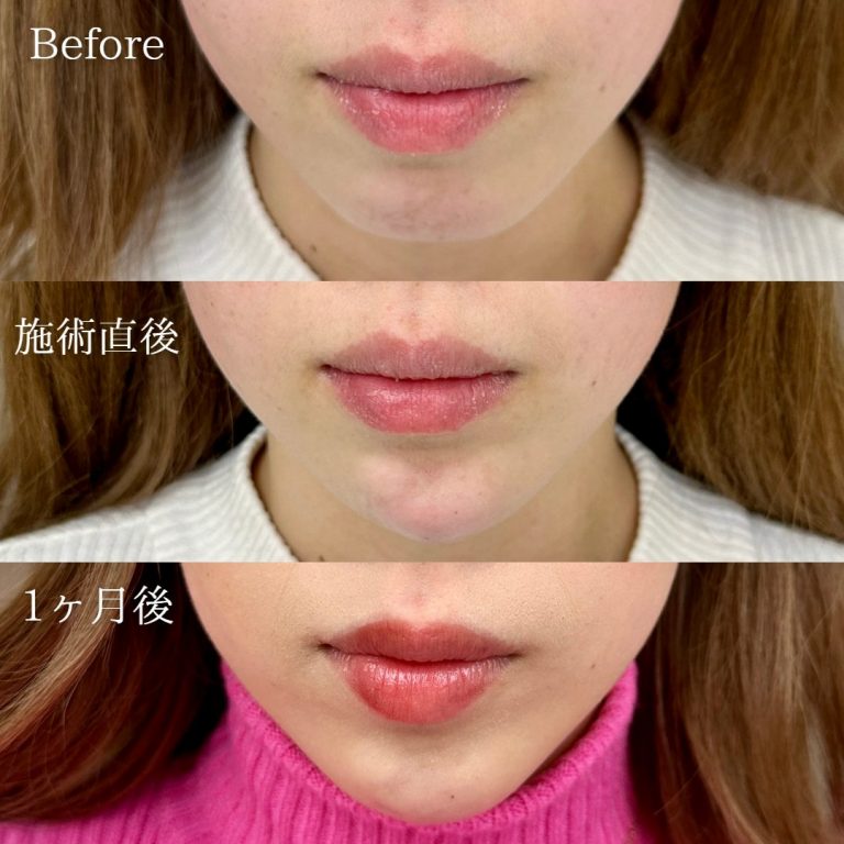 切らない顎形成 3D Eライン(担当医:林 弘樹 医師)の症例写真3