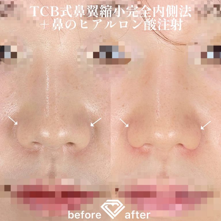 TCB式鼻翼縮小完全内側法・外側法(担当医:TCB 医師)の症例写真1