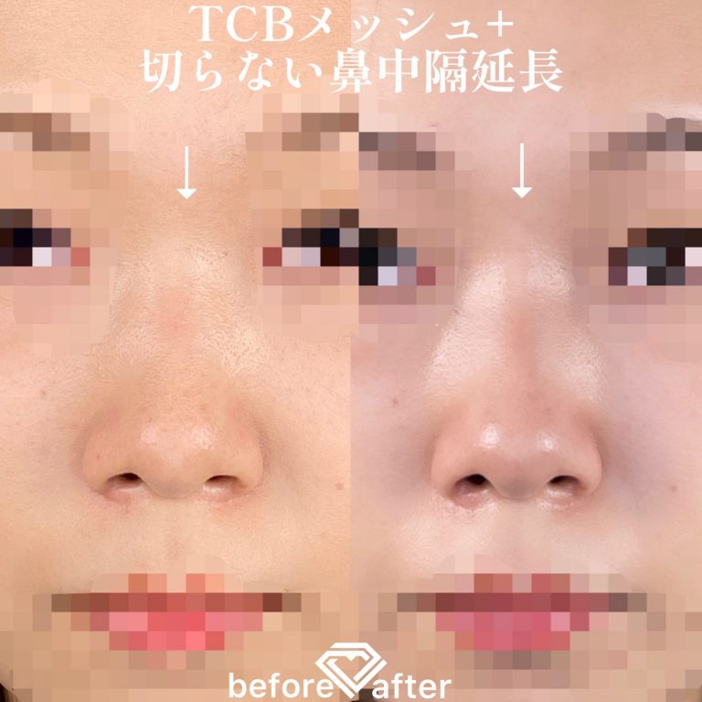 TCBメッシュ(担当医:TCB 医師)の症例写真1