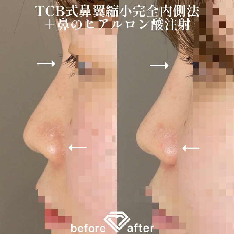 TCB式鼻翼縮小完全内側法・外側法(担当医:TCB 医師)の症例写真3