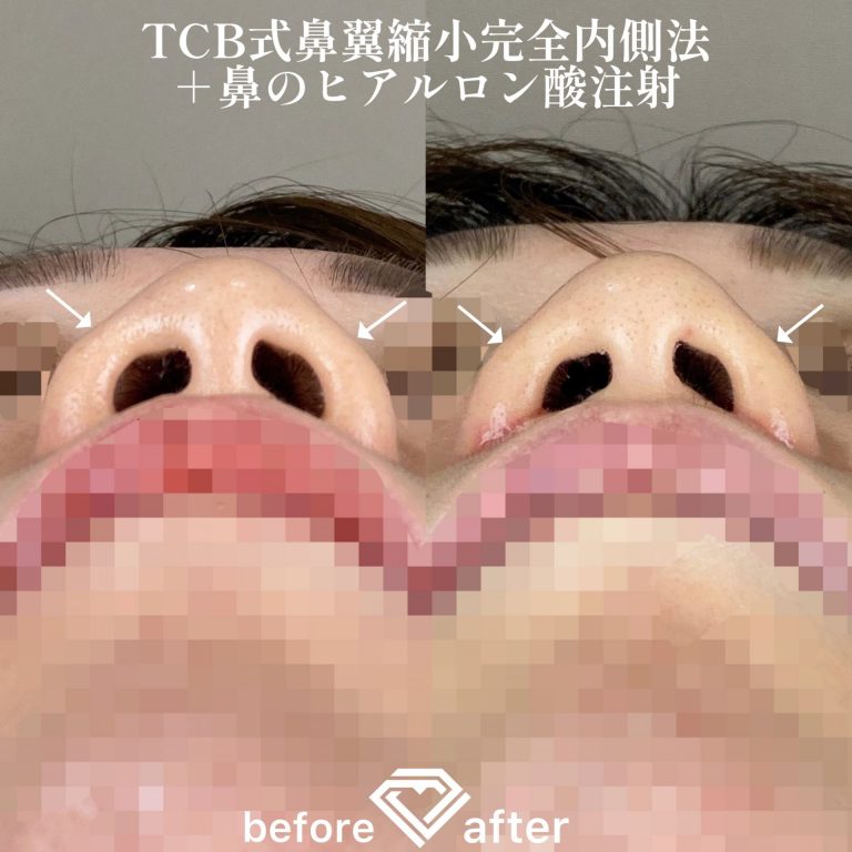 TCB式鼻翼縮小完全内側法・外側法(担当医:TCB 医師)の症例写真4