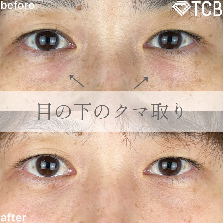 切らない目の下のクマ取り・目の下のたるみ（ふくらみ）取り(担当医:TCB 医師)の症例写真1
