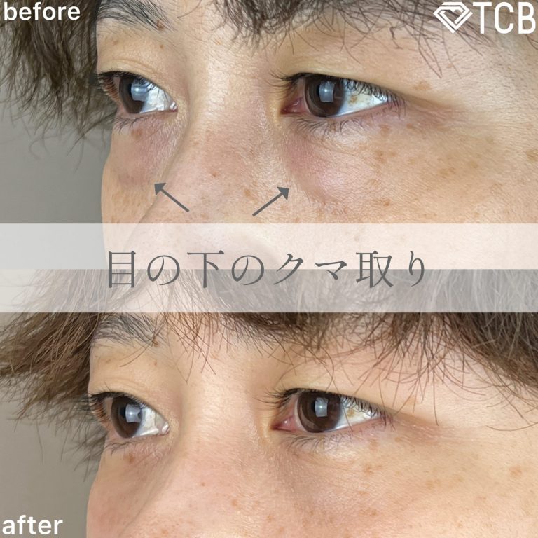 切らない目の下のクマ取り・目の下のたるみ（ふくらみ）取り(担当医:TCB 医師)の症例写真2
