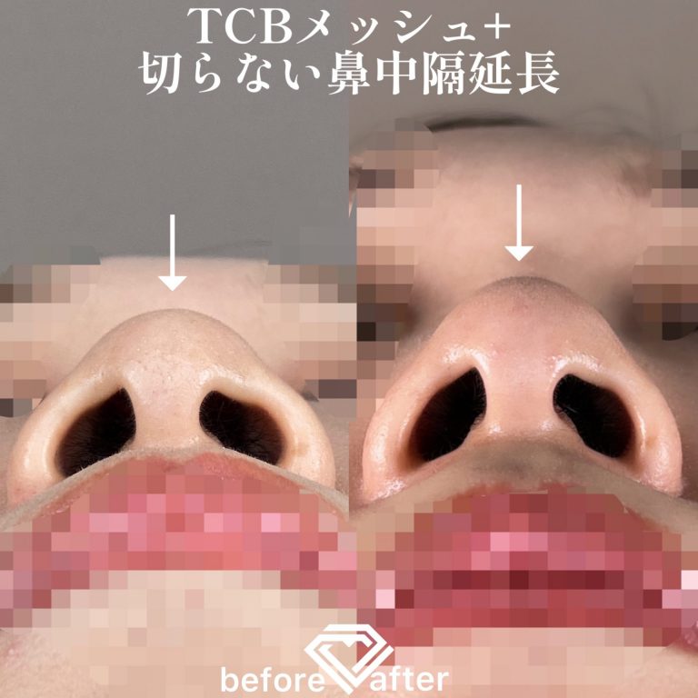 TCBメッシュ(担当医:TCB 医師)の症例写真4