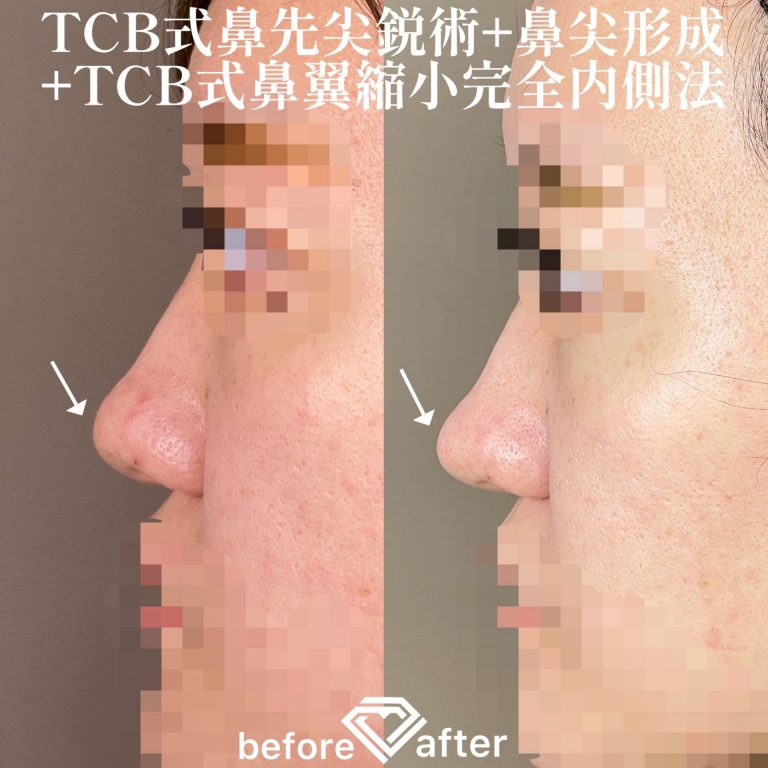 TCB式鼻先尖鋭術（だんご鼻解消）(担当医:TCB 医師)の症例写真2