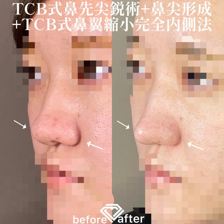 TCB式鼻先尖鋭術（だんご鼻解消）(担当医:TCB 医師)の症例写真3