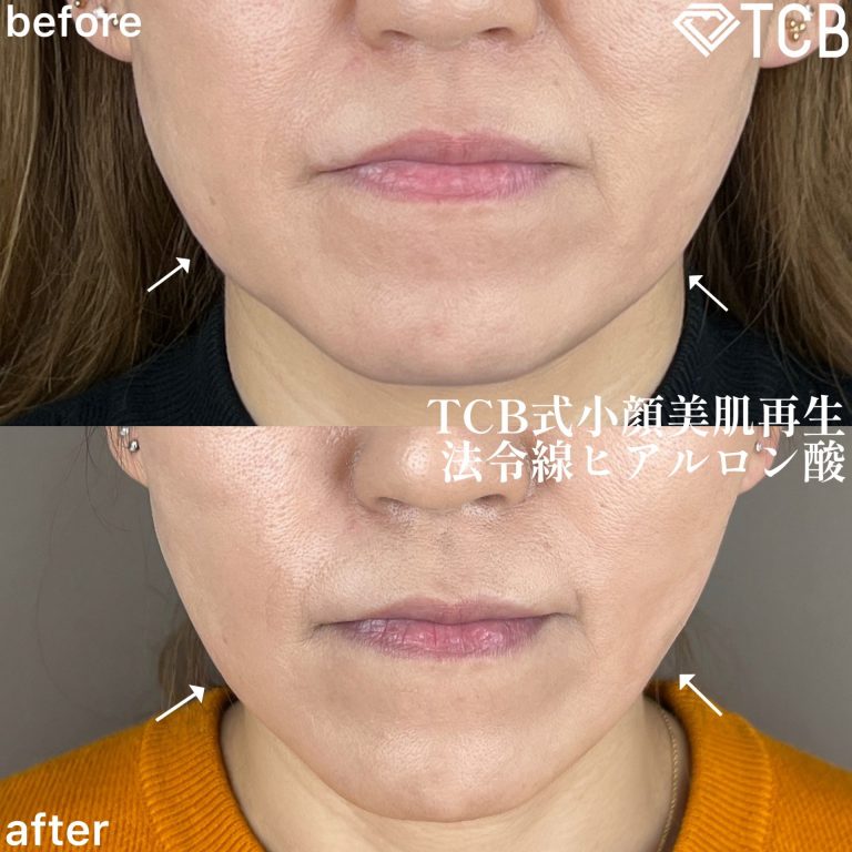 小顔美肌再生（リフトアップ）(担当医:TCB 医師)の症例写真1