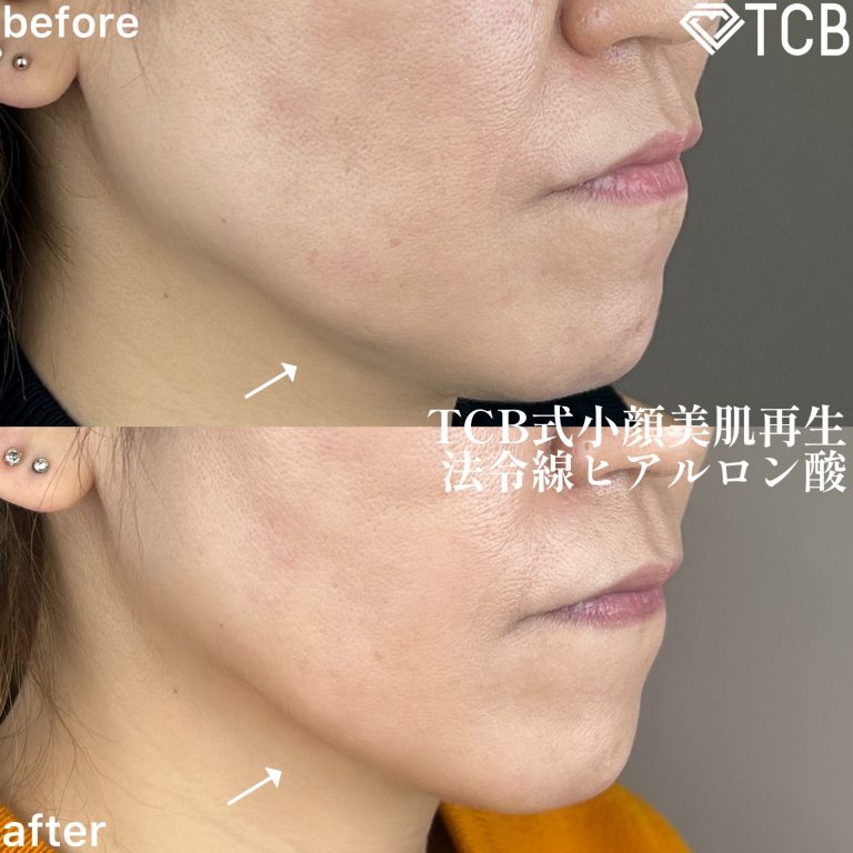 小顔美肌再生（リフトアップ）(担当医:TCB 医師)の症例写真2