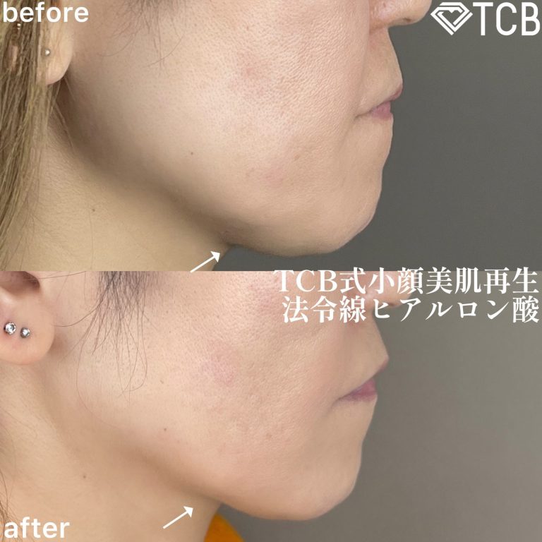 小顔美肌再生（リフトアップ）(担当医:TCB 医師)の症例写真3