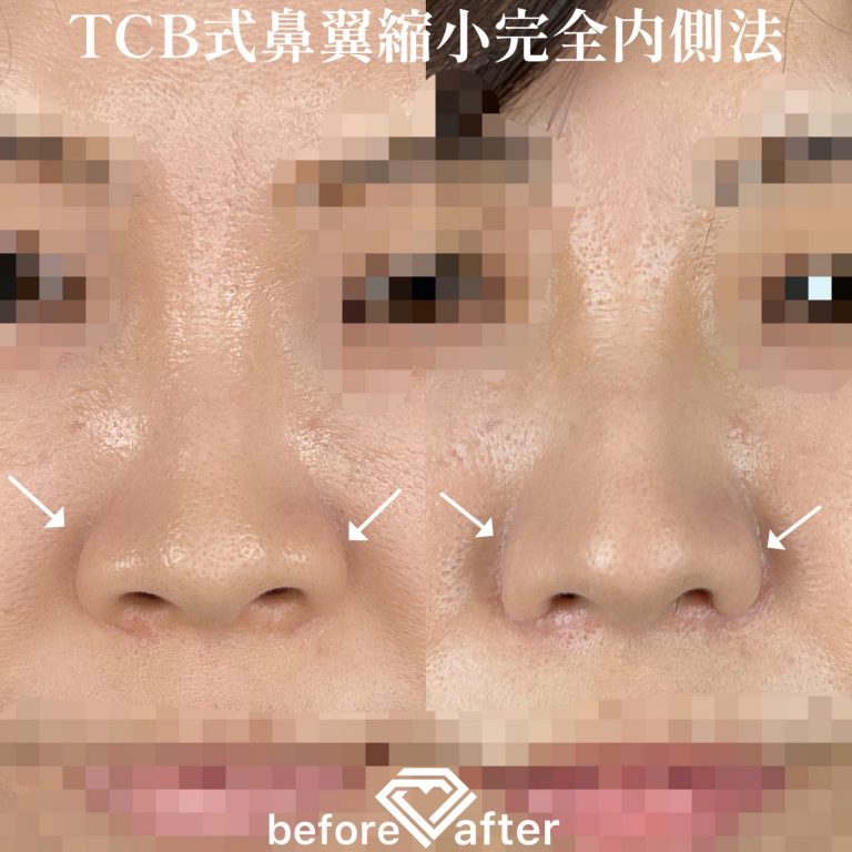 TCB式鼻翼縮小完全内側法・外側法(担当医:TCB 医師)の症例写真1