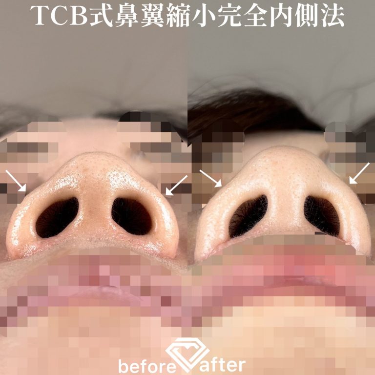 TCB式鼻翼縮小完全内側法・外側法(担当医:TCB 医師)の症例写真2