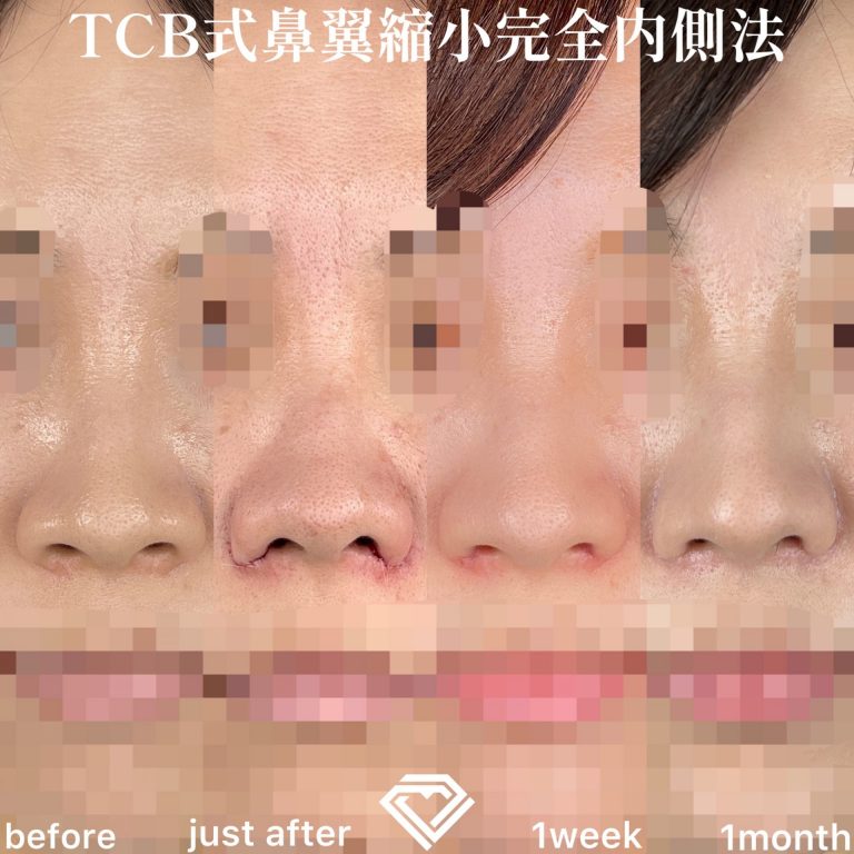 TCB式鼻翼縮小完全内側法・外側法(担当医:TCB 医師)の症例写真3