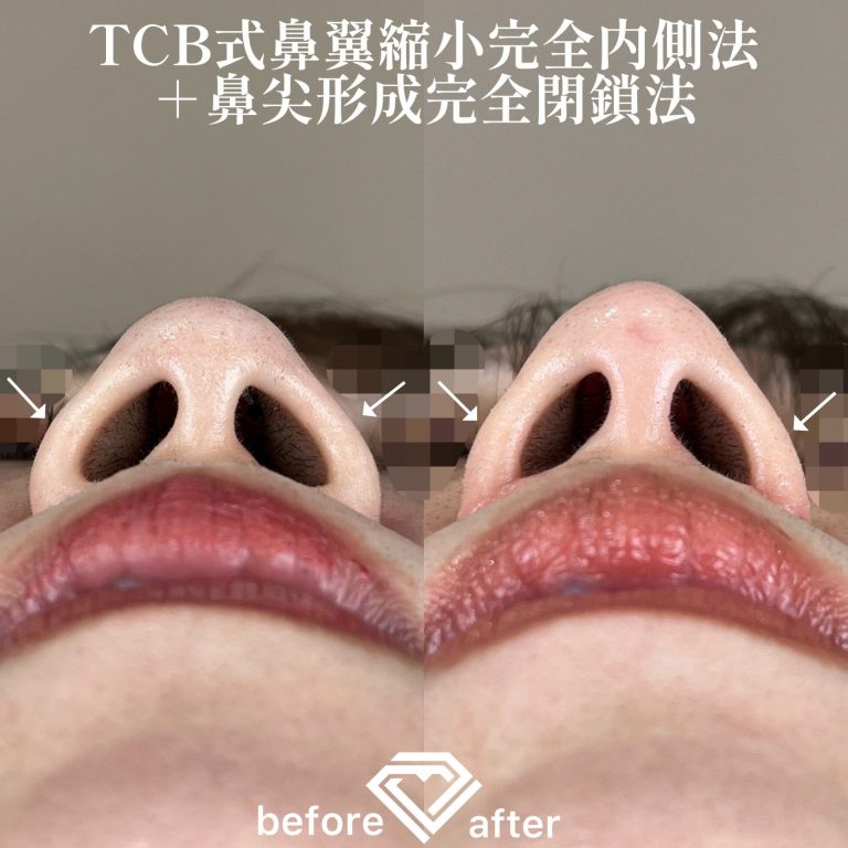 TCB式鼻翼縮小完全内側法・外側法(担当医:TCB 医師)の症例写真4