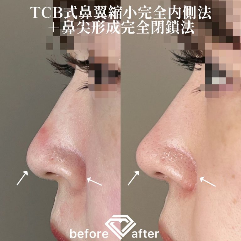 TCB式鼻翼縮小完全内側法・外側法(担当医:TCB 医師)の症例写真3