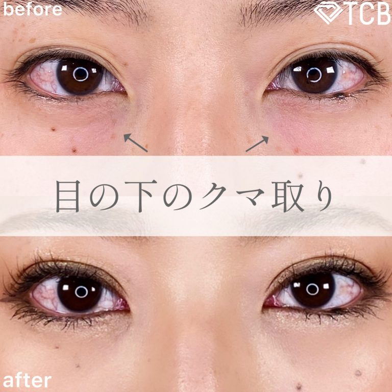 切らない目の下のクマ取り・目の下のたるみ（ふくらみ）取り(担当医:TCB 医師)の症例写真1
