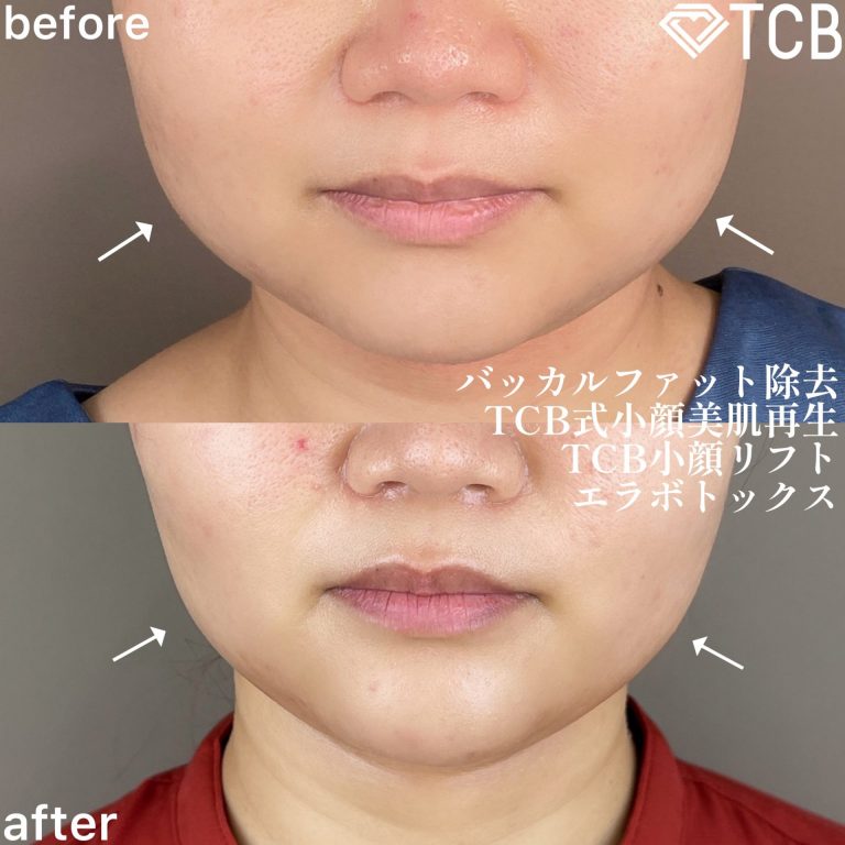 小顔美肌再生（リフトアップ）(担当医:TCB 医師)の症例写真1