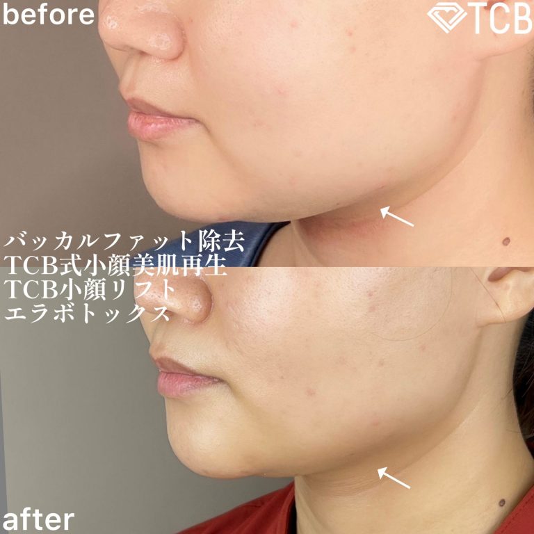 小顔美肌再生（リフトアップ）(担当医:TCB 医師)の症例写真2