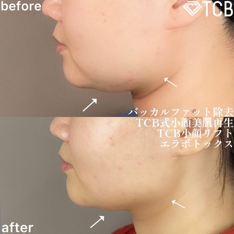 小顔美肌再生（リフトアップ）(担当医:TCB 医師)の症例写真3