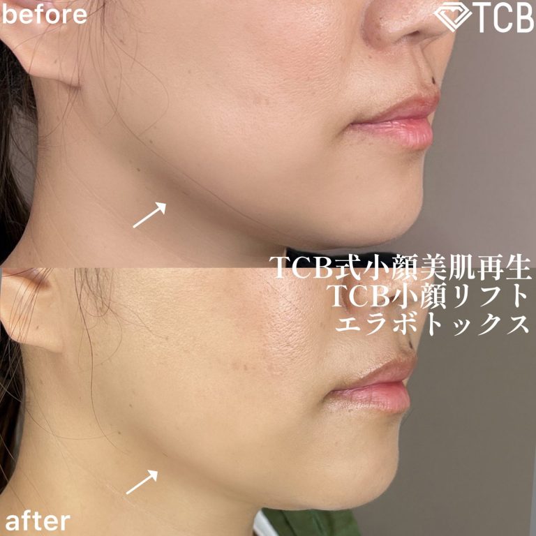 小顔美肌再生（リフトアップ）(担当医:TCB 医師)の症例写真2