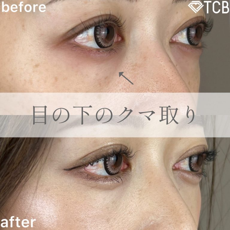 切らない目の下のクマ取り・目の下のたるみ（ふくらみ）取り(担当医:TCB 医師)の症例写真2