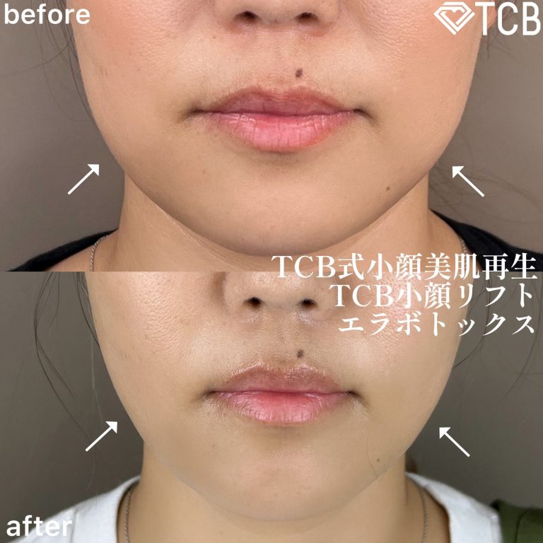 小顔美肌再生（リフトアップ）(担当医:TCB 医師)の症例写真1