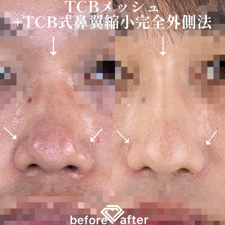 TCB式鼻翼縮小完全内側法・外側法(担当医:TCB 医師)の症例写真1