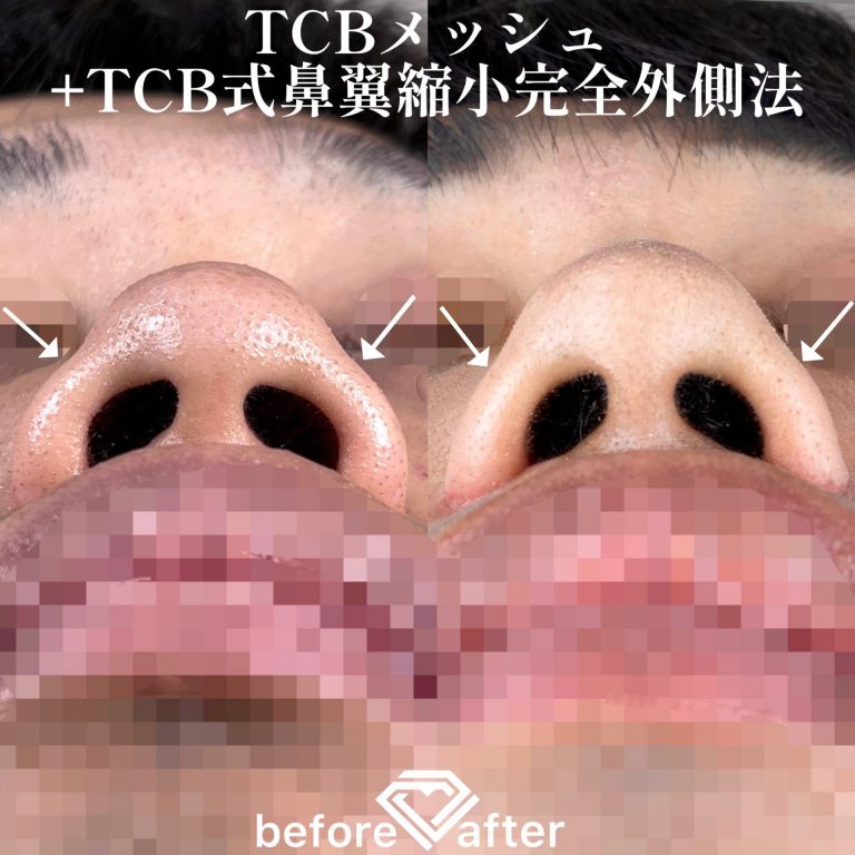 TCB式鼻翼縮小完全内側法・外側法(担当医:TCB 医師)の症例写真3