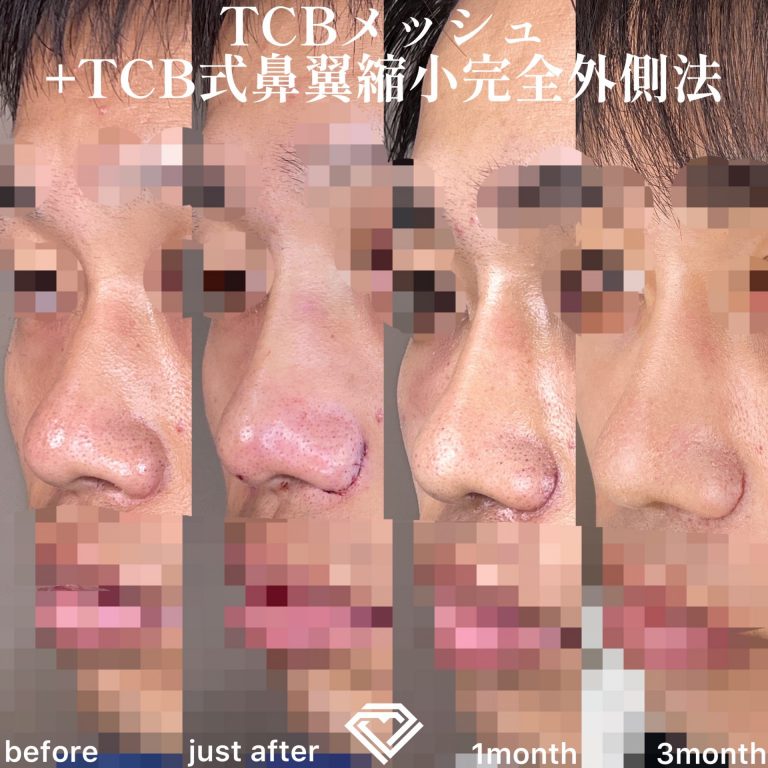 TCB式鼻翼縮小完全内側法・外側法(担当医:TCB 医師)の症例写真2