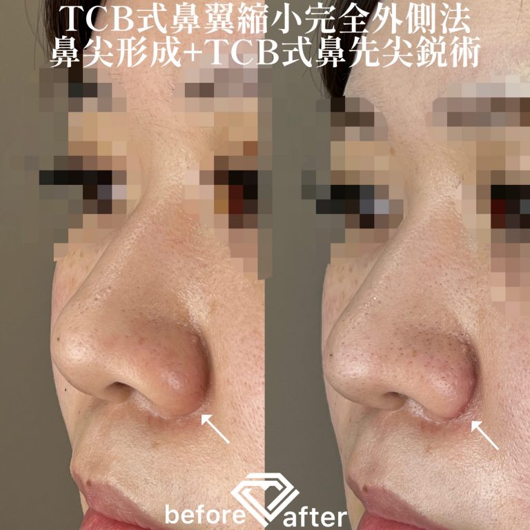 TCB式鼻翼縮小完全内側法(担当医:森本 理一郎 医師)の症例写真2