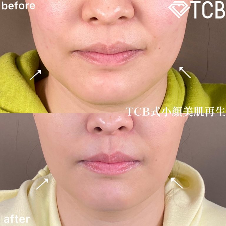 小顔美肌再生（リフトアップ）(担当医:TCB 医師)の症例写真1