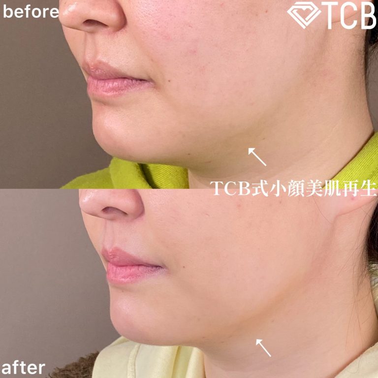 小顔美肌再生（リフトアップ）(担当医:TCB 医師)の症例写真2