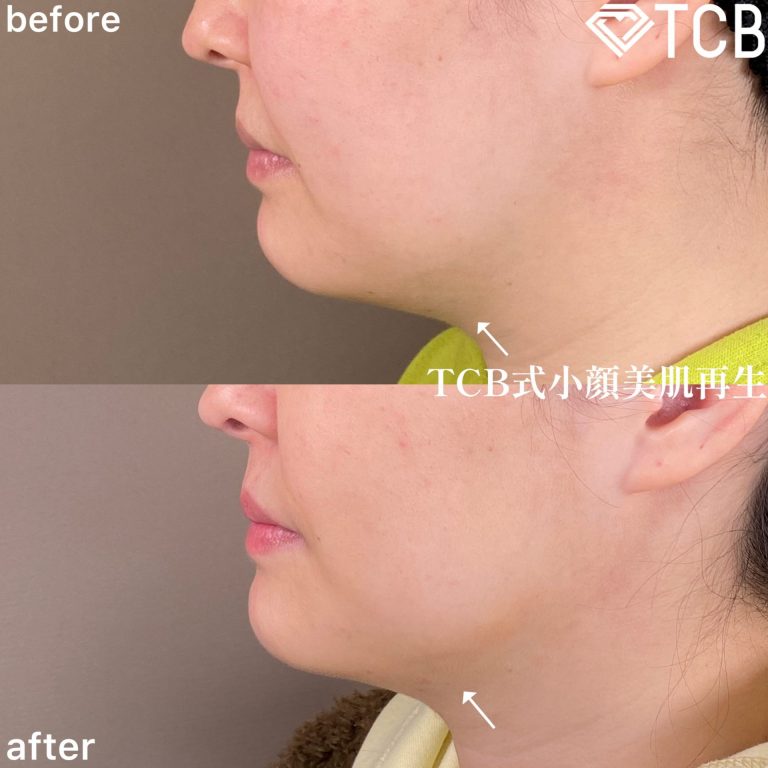 小顔美肌再生（リフトアップ）(担当医:TCB 医師)の症例写真3