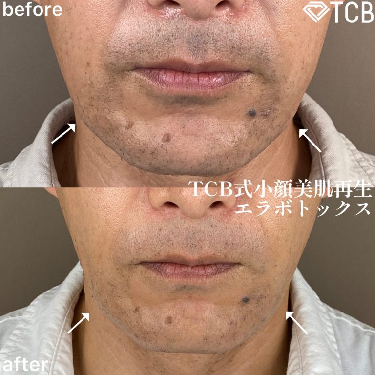 小顔美肌再生（リフトアップ）(担当医:TCB 医師)の症例写真1