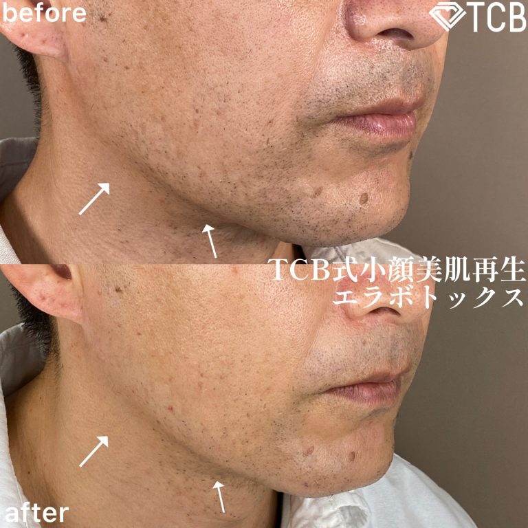 小顔美肌再生（リフトアップ）(担当医:TCB 医師)の症例写真2