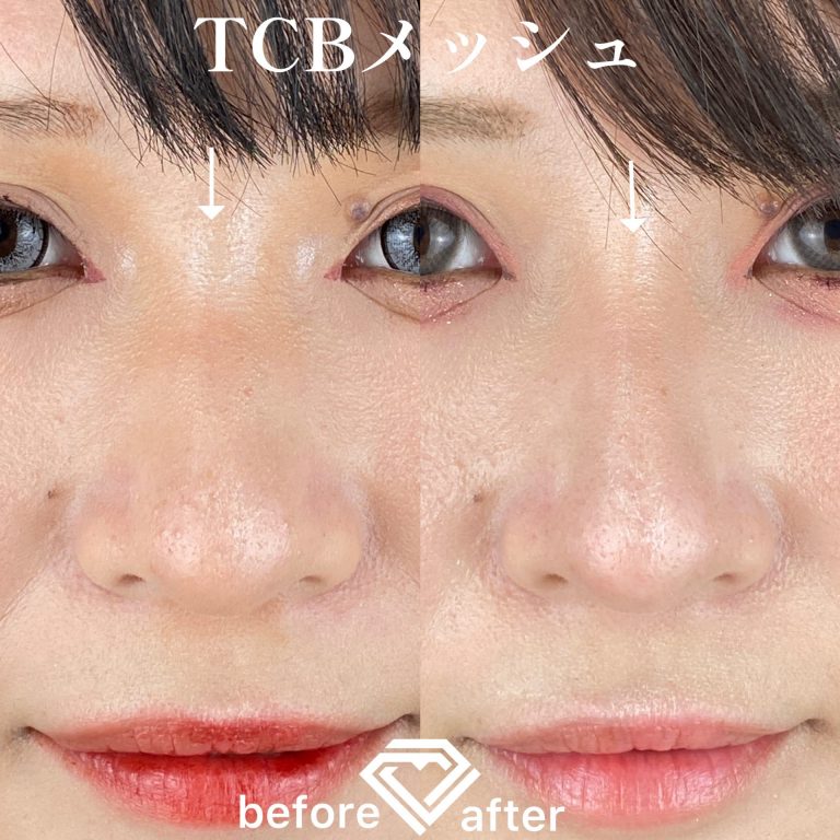 TCBメッシュ(担当医:TCB 医師)の症例写真1