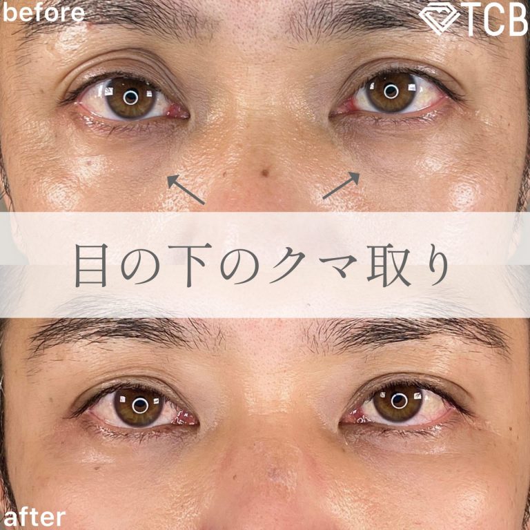 切らない目の下のクマ取り・目の下のたるみ（ふくらみ）取り(担当医:TCB 医師)の症例写真1