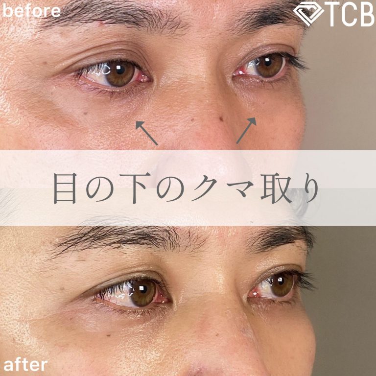 切らない目の下のクマ取り・目の下のたるみ（ふくらみ）取り(担当医:TCB 医師)の症例写真2