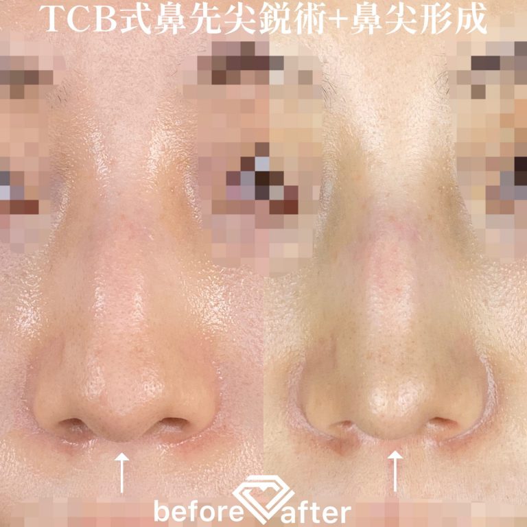 TCB式鼻先尖鋭術（だんご鼻解消）(担当医:TCB 医師)の症例写真1