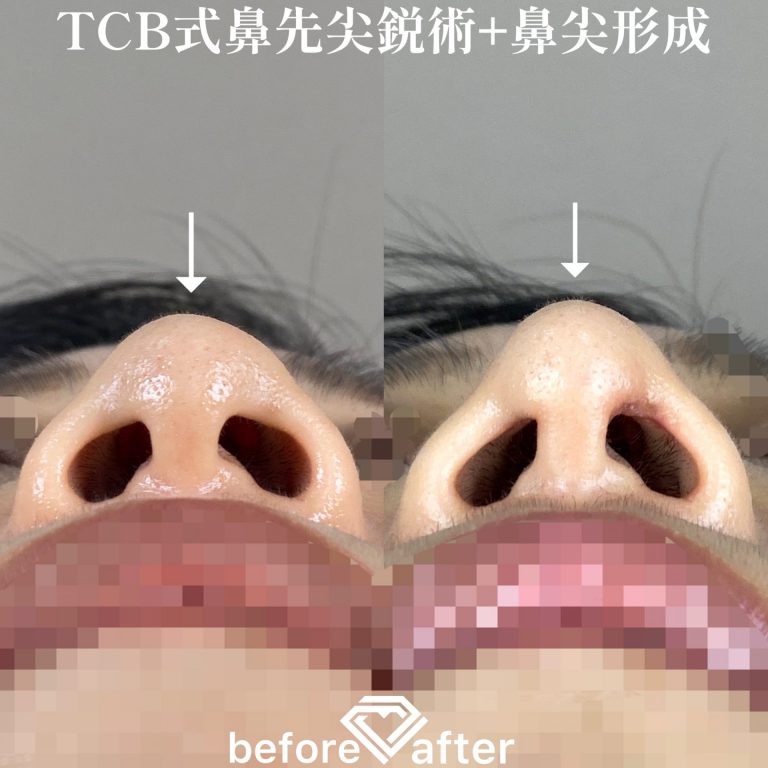 TCB式鼻先尖鋭術（だんご鼻解消）(担当医:TCB 医師)の症例写真4