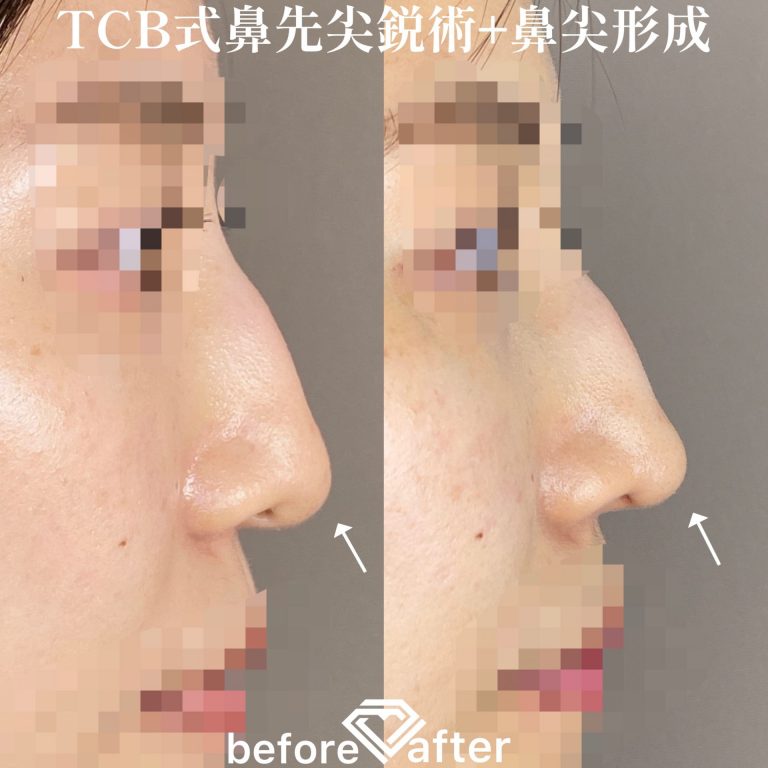 TCB式鼻先尖鋭術（だんご鼻解消）(担当医:TCB 医師)の症例写真3