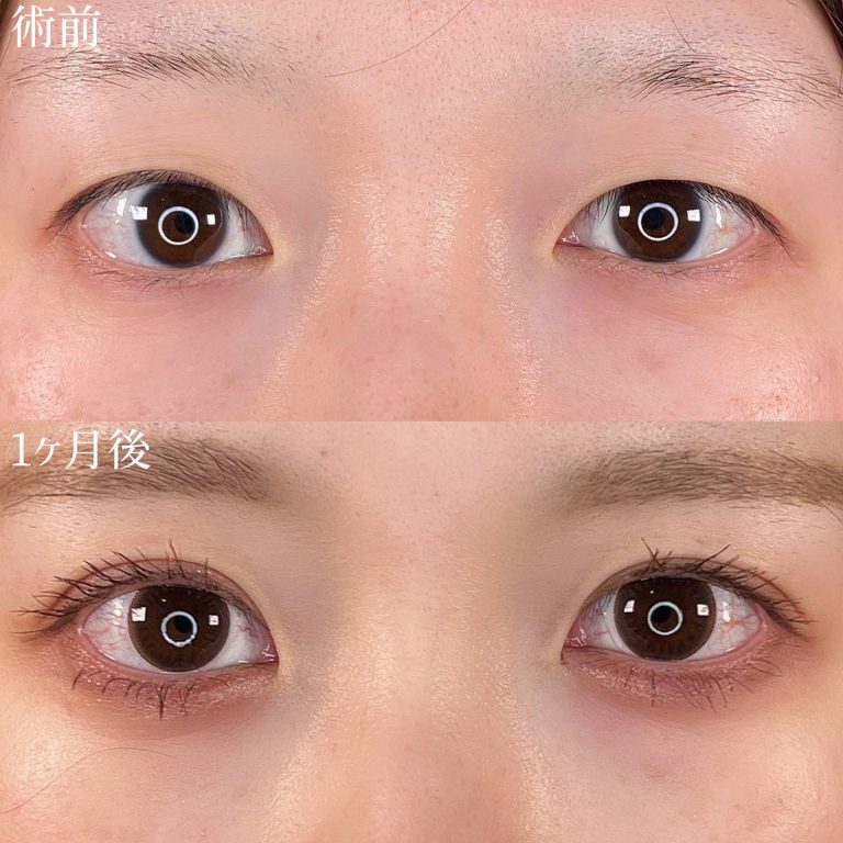 二重埋没法(担当医:TCB 医師)の症例写真2