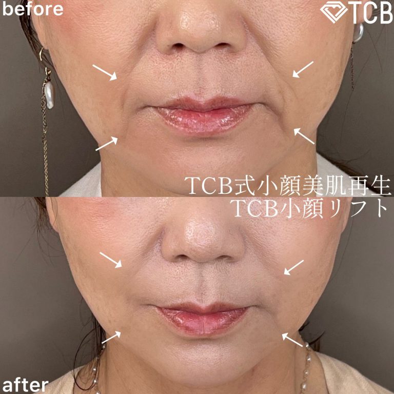 小顔美肌再生（リフトアップ）(担当医:TCB 医師)の症例写真1