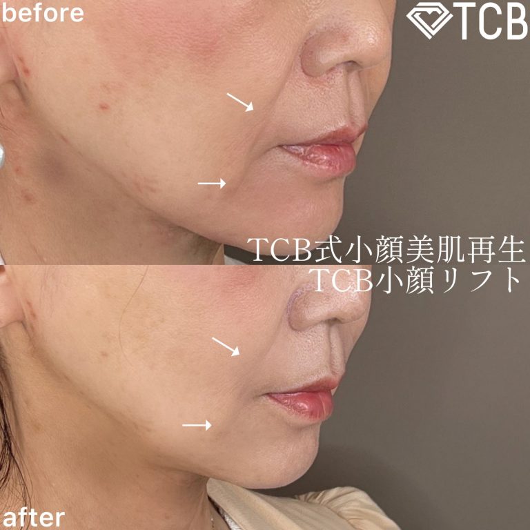 小顔美肌再生（リフトアップ）(担当医:TCB 医師)の症例写真2