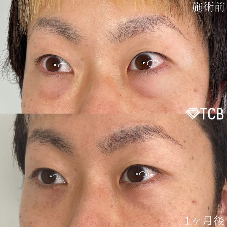 切らない目の下のクマ取り・目の下のたるみ（ふくらみ）取り(担当医:TCB 医師)の症例写真1